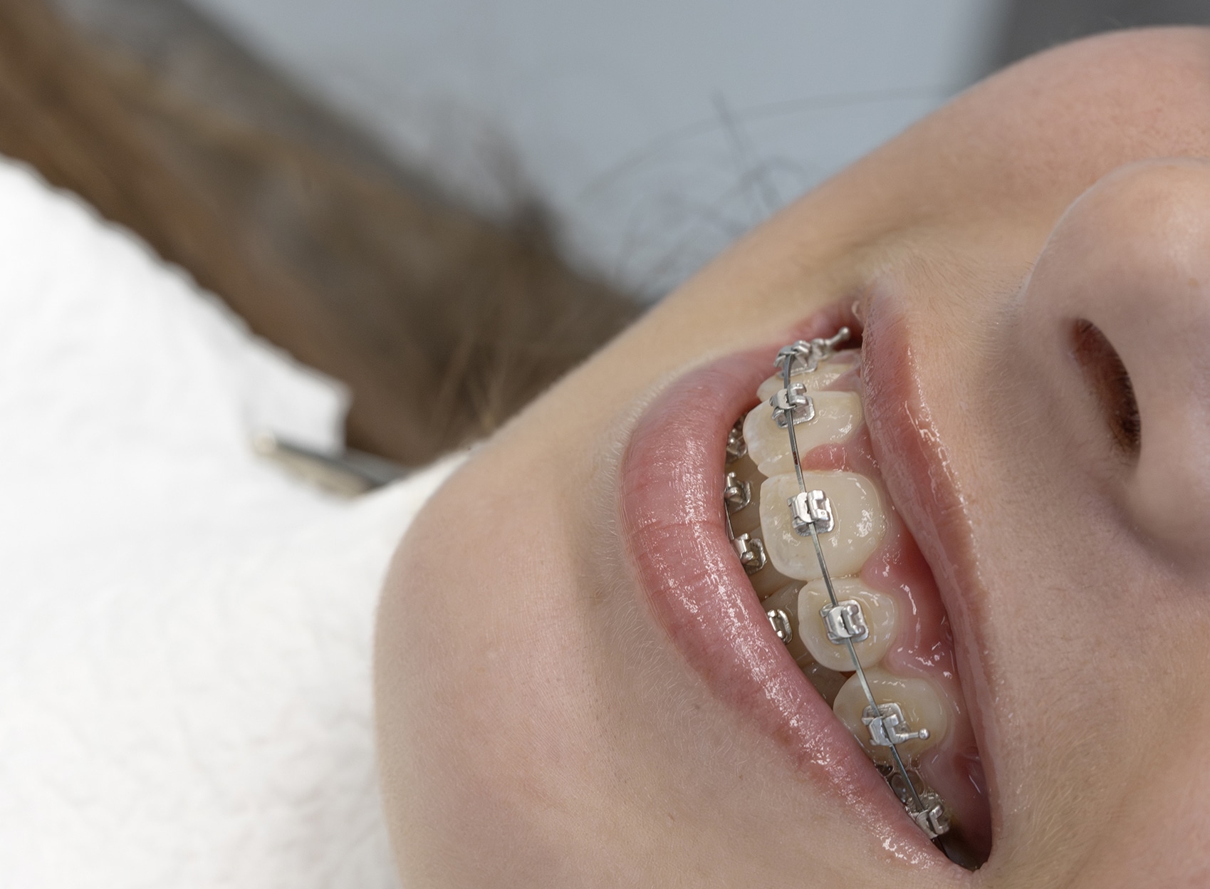 Teeth Braces in Dubai