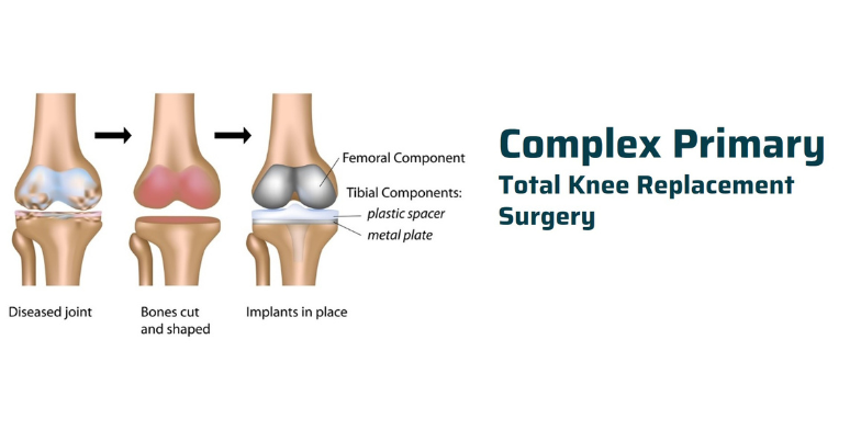 Robotic Knee Replacement – Advanced Precision for a Pain-Free Life