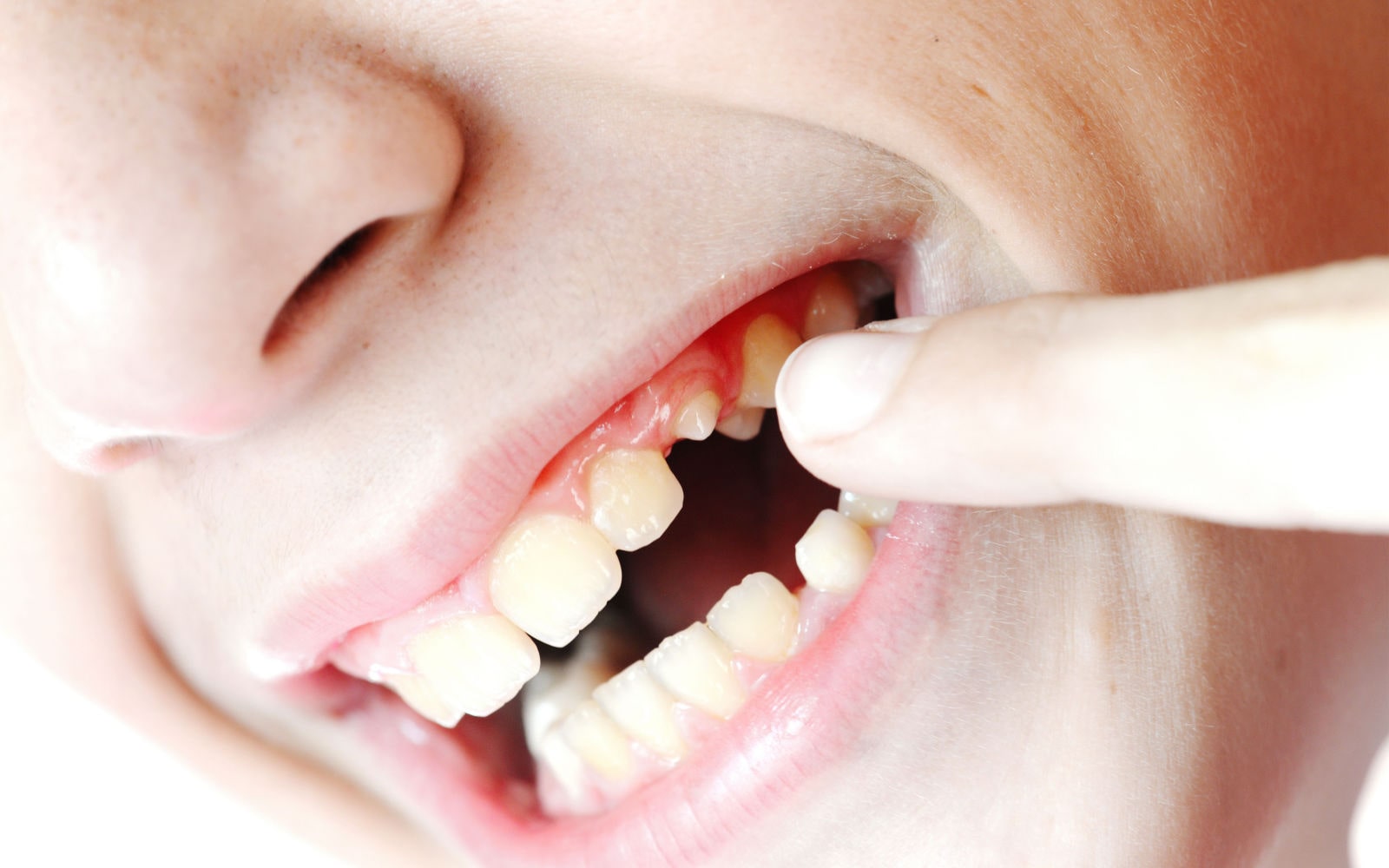 What Happens When a Tooth Breaks at the Gum Line?