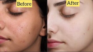 Top Facial Treatments for Smooth and Acne Free Skin Results