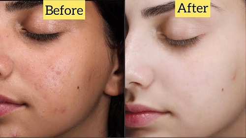 Top Facial Treatments for Smooth and Acne Free Skin Results